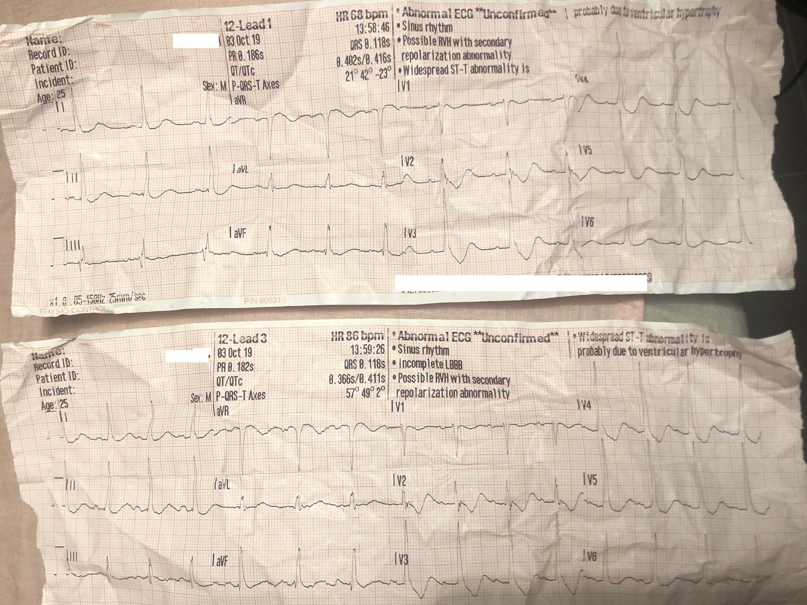 Weakness ECG